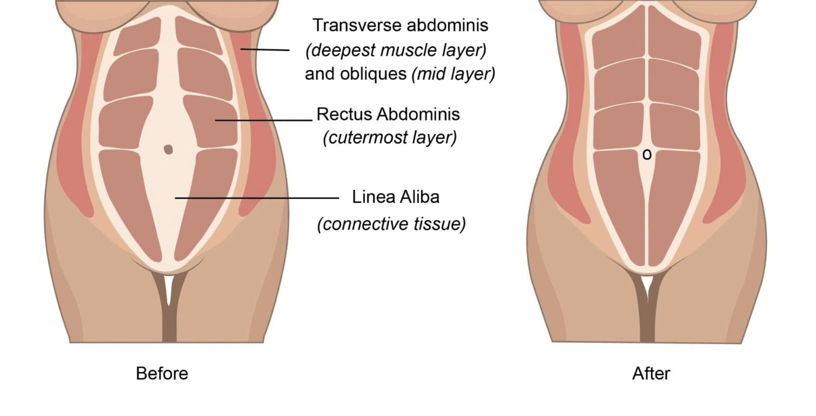 Tummy Tuck - Medwork Clinic